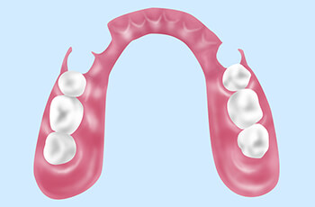 ノンクラスプデンチャー（自費診療）