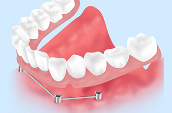 インプラントオーバーデンチャー（自費診療）