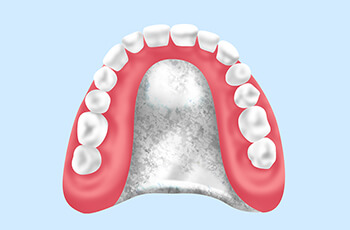 自費診療の入れ歯