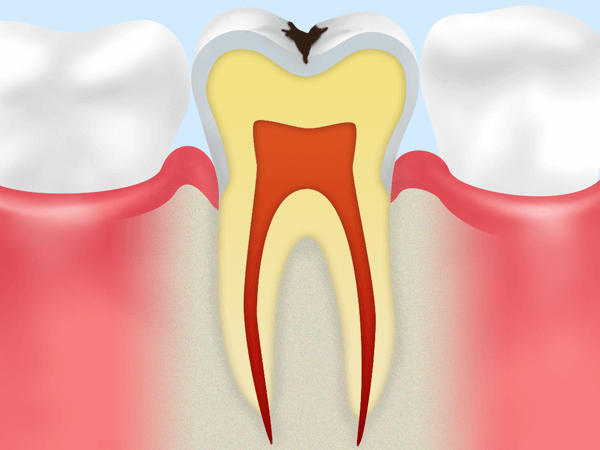 C1 エナメル質の虫歯