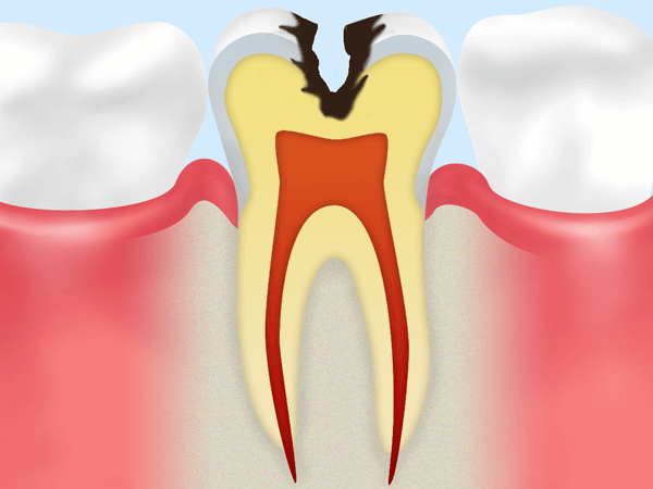 C2 象牙質の虫歯