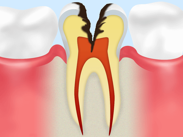 C3 神経におよんだ虫歯