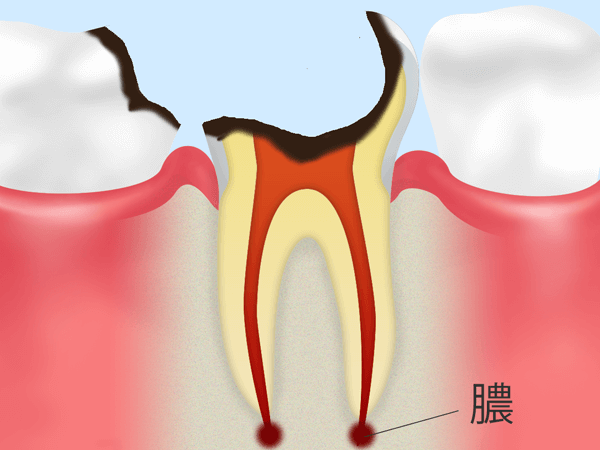 C4 歯の根に達した虫歯