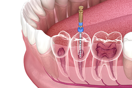 虫歯は早期発見・早期治療、そして予防が大切です