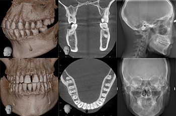 詳細情報を立体画像で把握～歯科用CT～