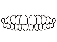 空隙歯列（すきっ歯）