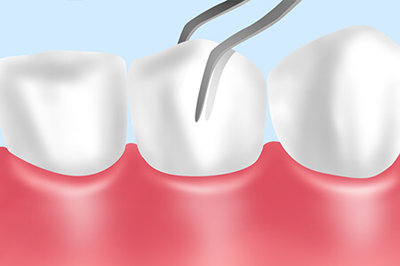 歯の揺度検査